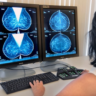 ‘Dit is de toekomst van kankertherapie’: nieuwe test kan vrouwen chemotherapie besparen