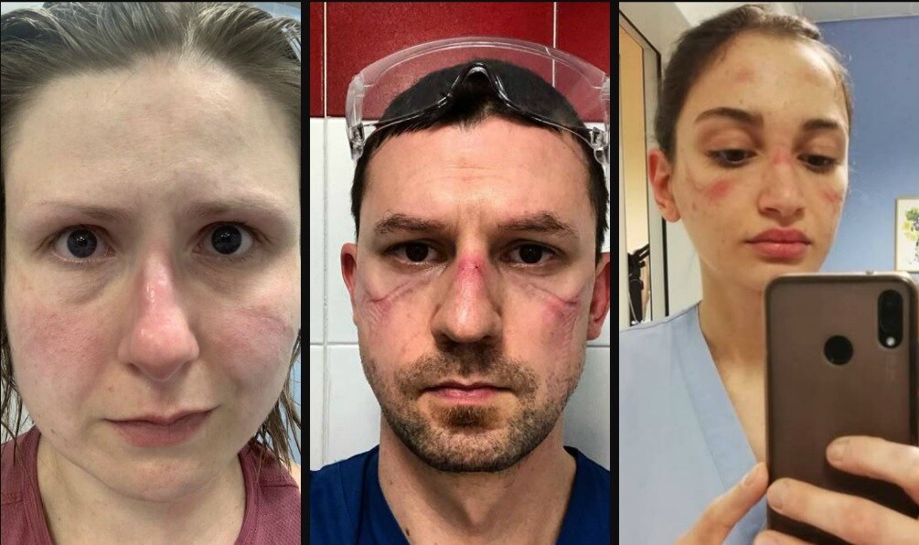 ‘Ik voel me kapot en we zitten nog maar in het begin’: beschermende maskers van verplegers laten littekens na